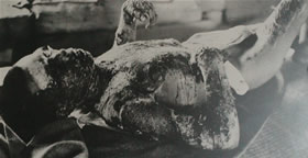 A Hiroshima victim 3000 meters from the blast.