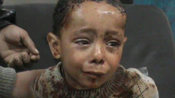 Syrian child wounded by bombing of Damascus.